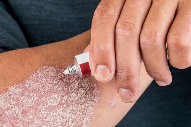 How is Psoriasis Treated